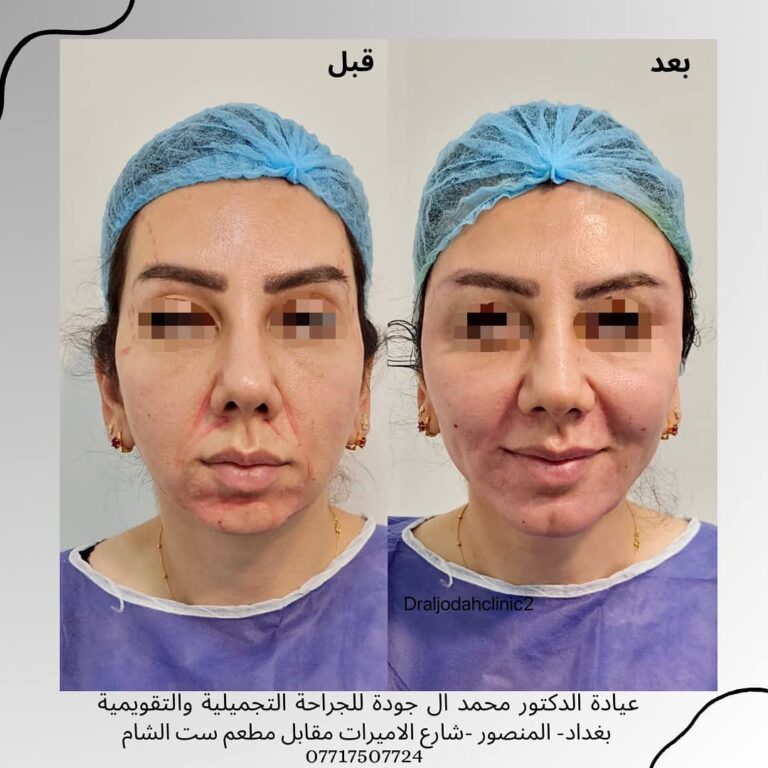 حقن شحوم 2 768x768