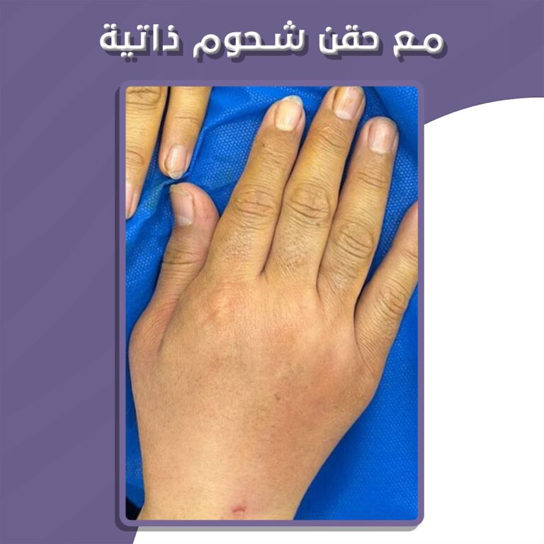 حقن شحوم 3 768x768