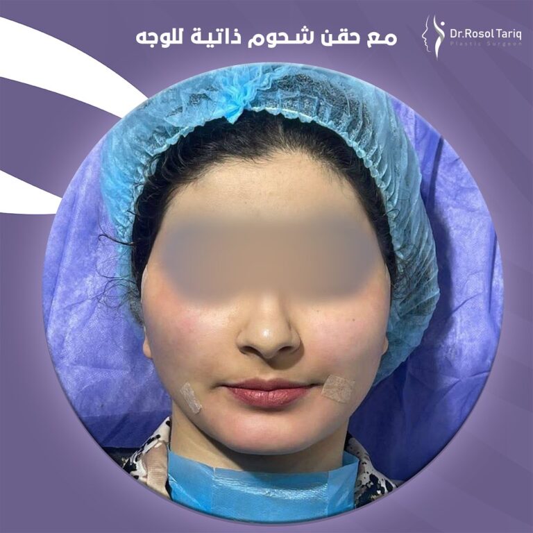 حقن شحوم الوجه 768x768