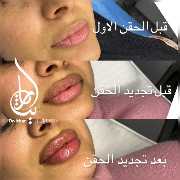 حقن شفاة 768x768