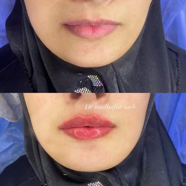 حقن شفاه 768x768