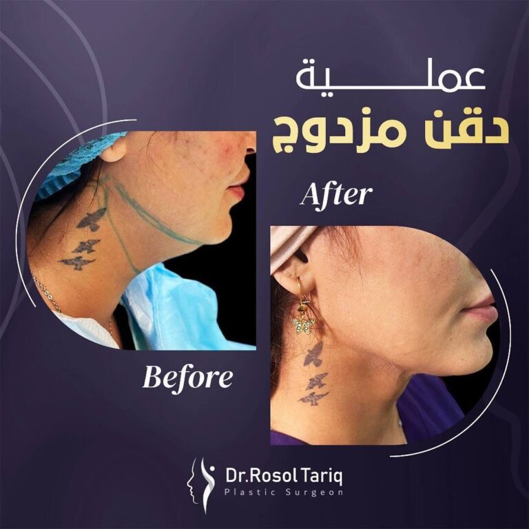 حقن مزدوج 768x768