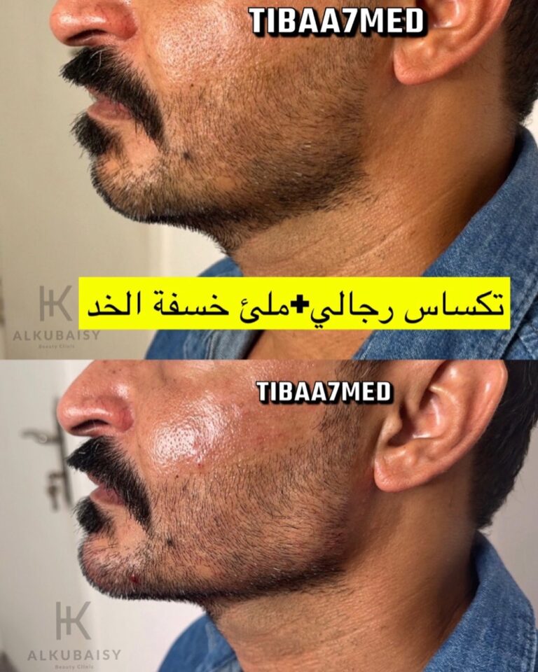 خسفه الخد 768x960