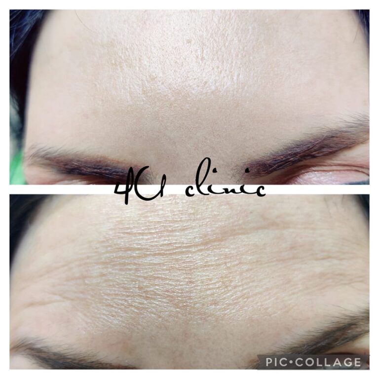 خطوط الجبين 768x768