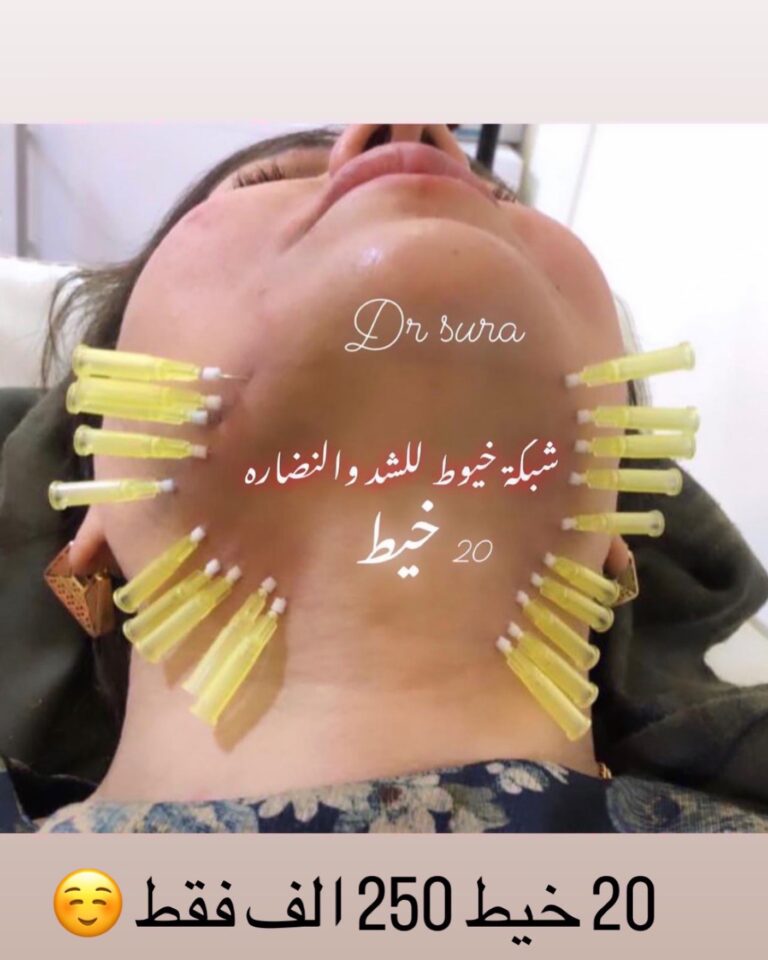 خيوط الشد 768x960
