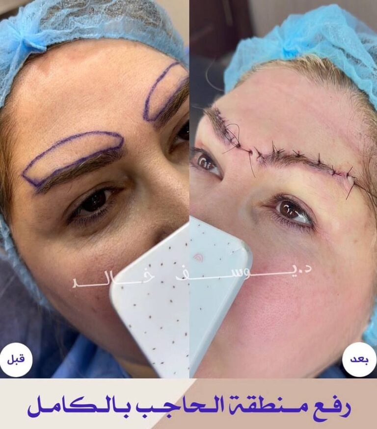 رفع الحاجب 768x872