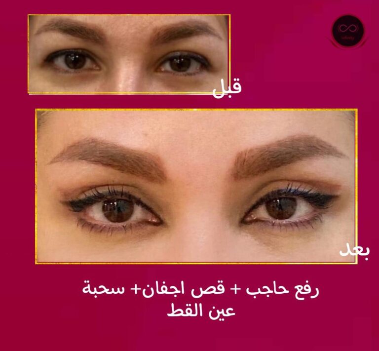 رفع حاجب فص اجفان سحب عين 768x711