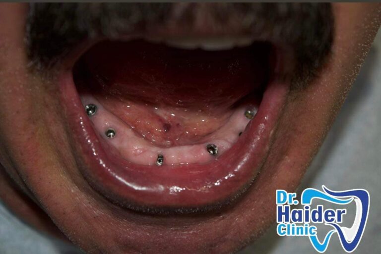 زراعة اسنان 1 768x513