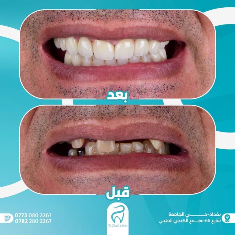 زراعة اسنان 768x768