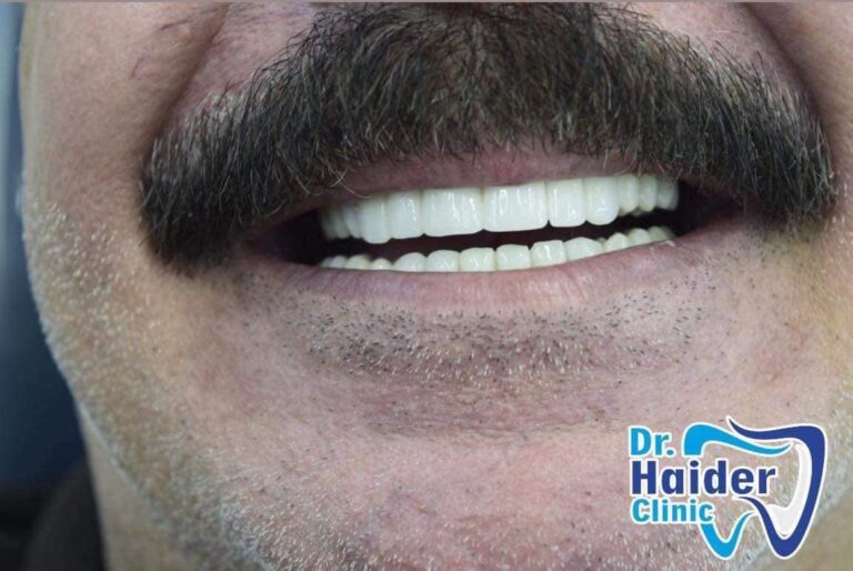 زراعه اسنان 3 768x514