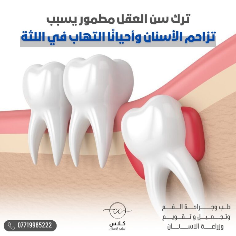 زراعه اسنان 5 768x768