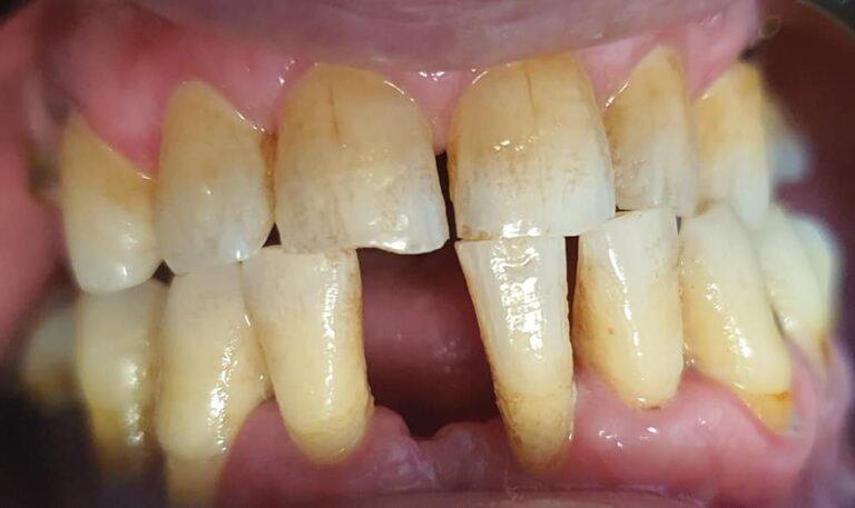 زراعه اسنان 6 768x457