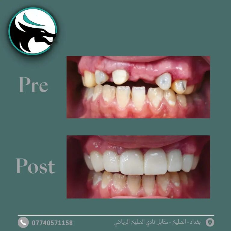 زراعه اسنان 7 768x768