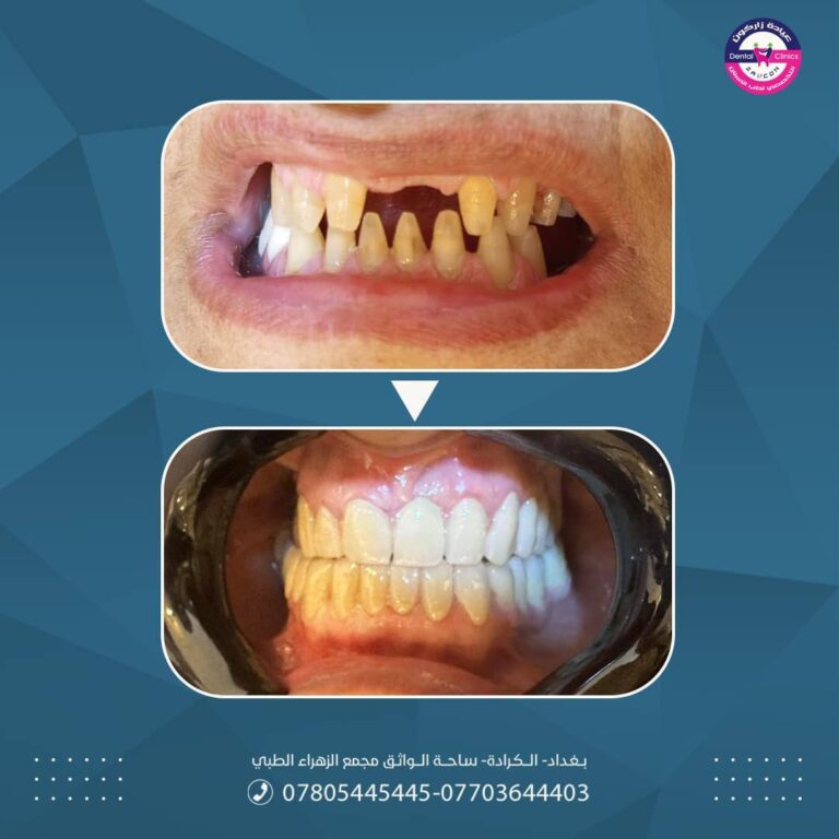 زراعه اسنان 768x768