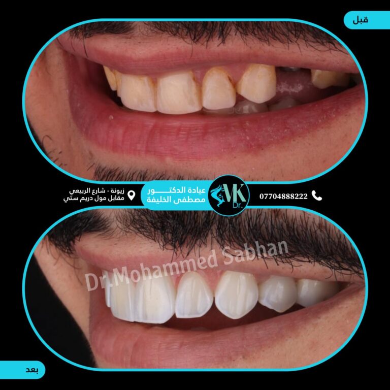 زراعه اسنان 768x768