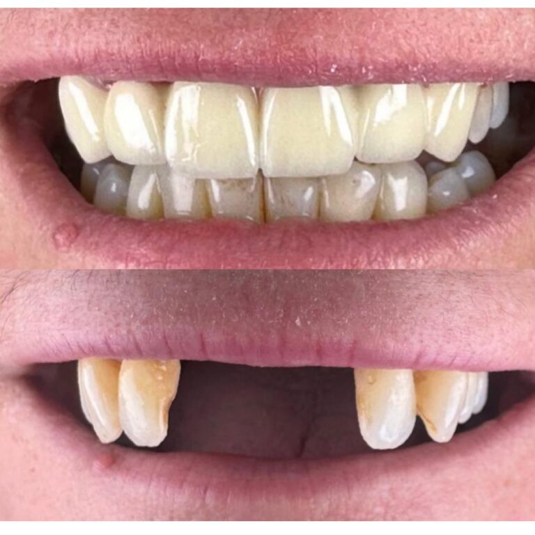 زراعه الاسنان 3 768x768