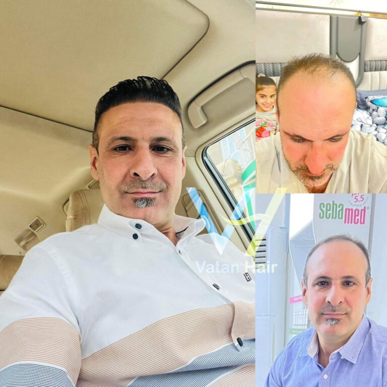 زراعه شعر 1 1 768x768