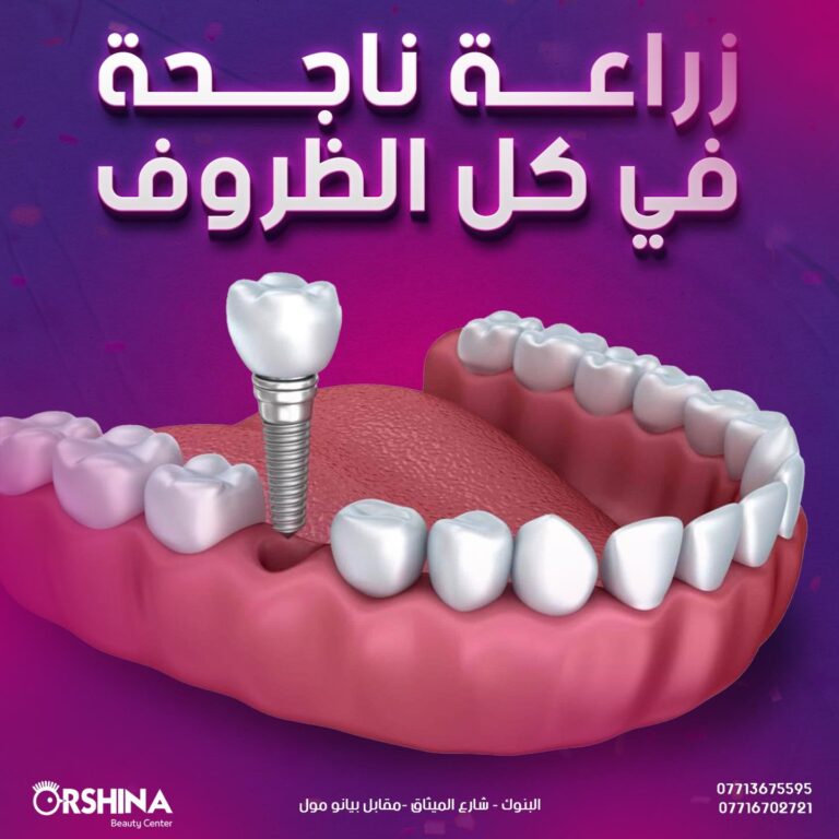 زرع اسنان 768x768