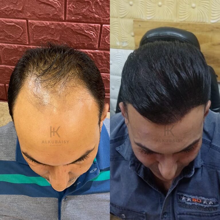 زرع شعر 768x768