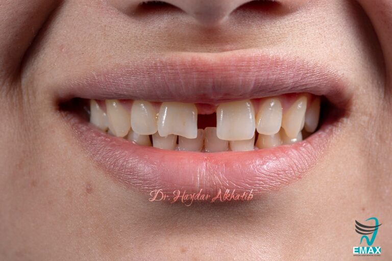 سد الفراغات 2 768x512