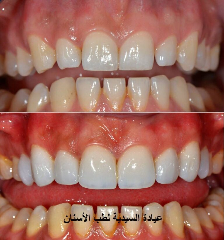 سد الفراغات 768x825