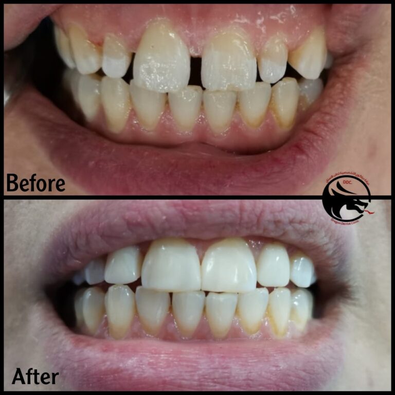 سد فراغات الاسنان 2 768x768