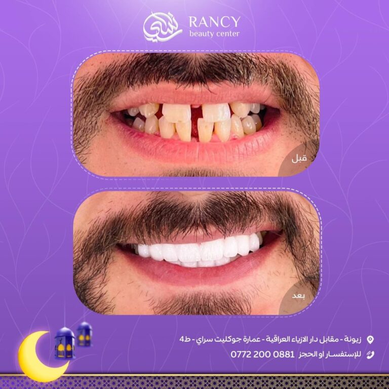 سد فراغات الاسنان 3 768x768