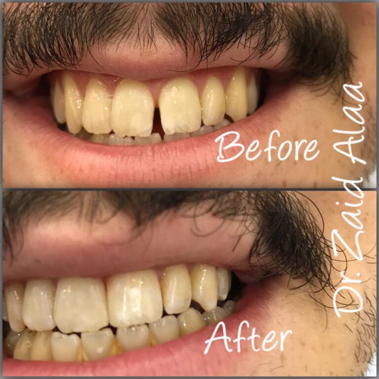 سد فراغات الاسنان 768x768