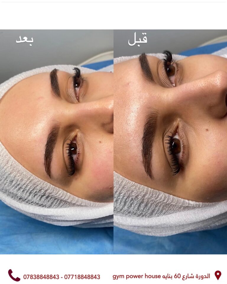 سوفت فلر تحت العين 768x960