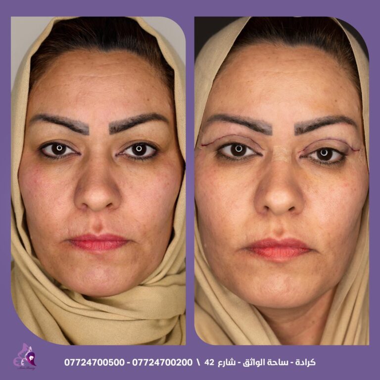 شد الاجفان 768x768