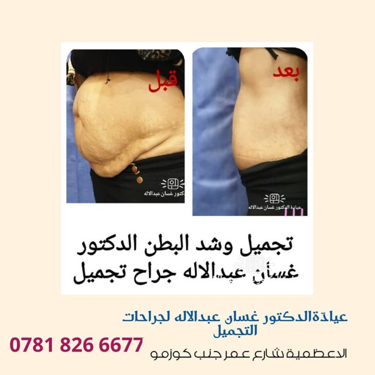 شد البطن 1 768x768