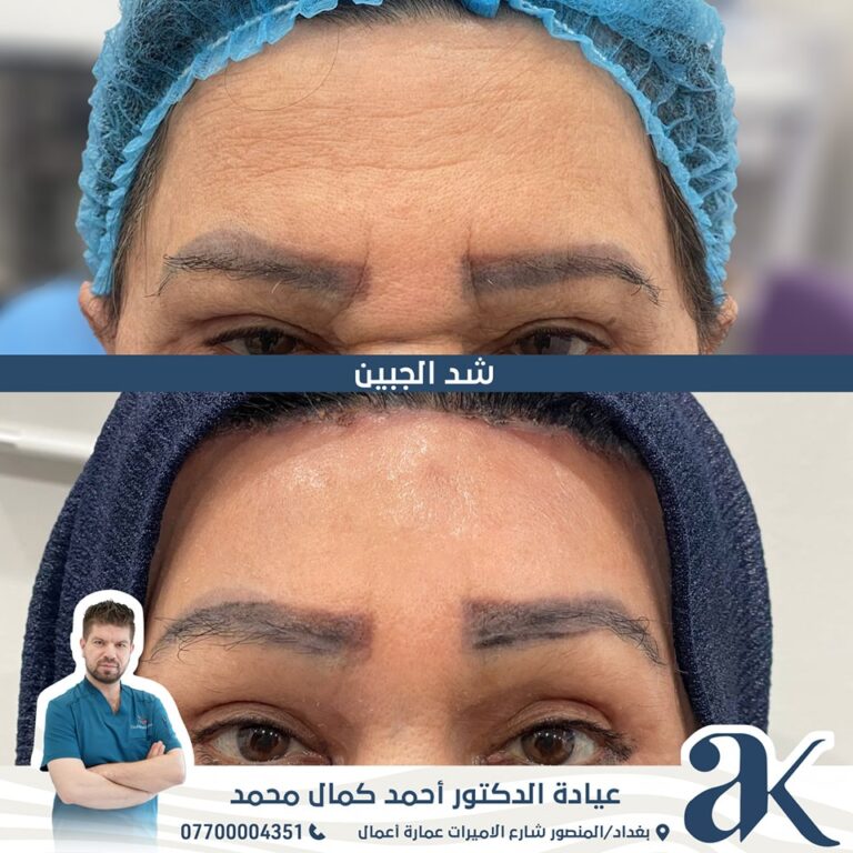 شد الجبين 768x768