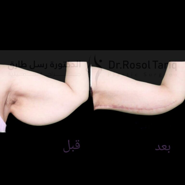 شد الذراعين 768x768