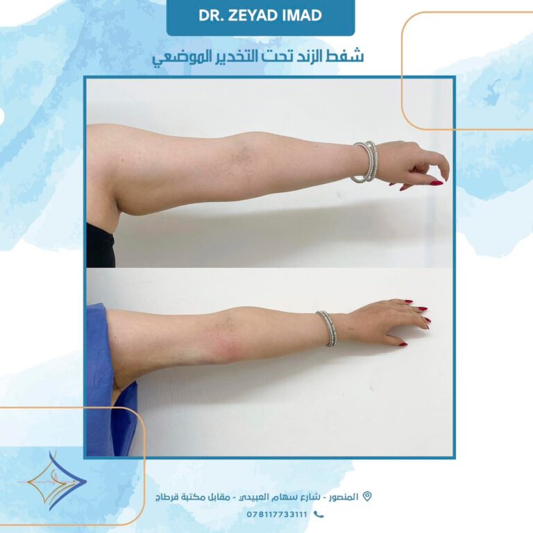 شد الزند 768x768