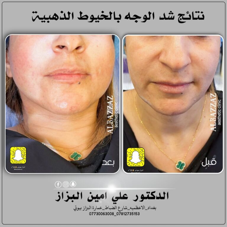 شد الوجه 5 768x768