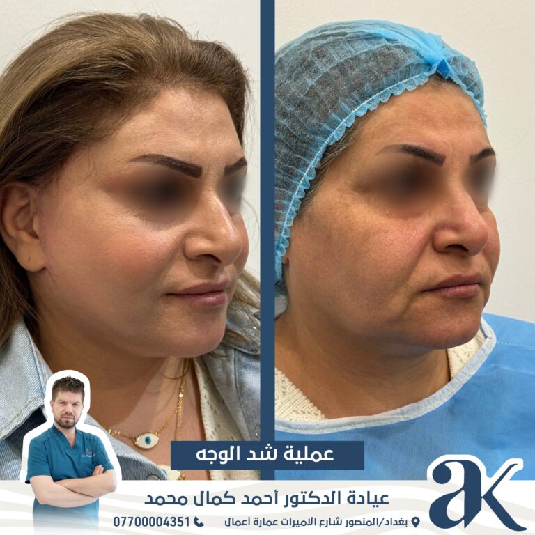 شد الوجه 6 768x768