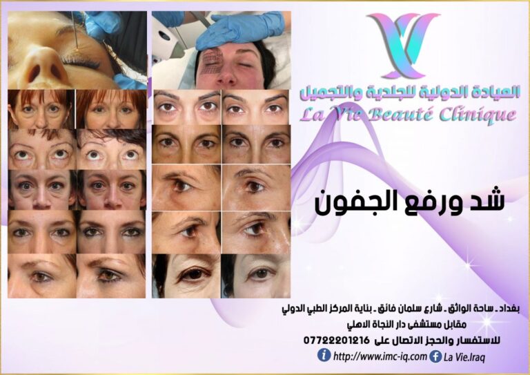 شد ورفع الجفون 768x543
