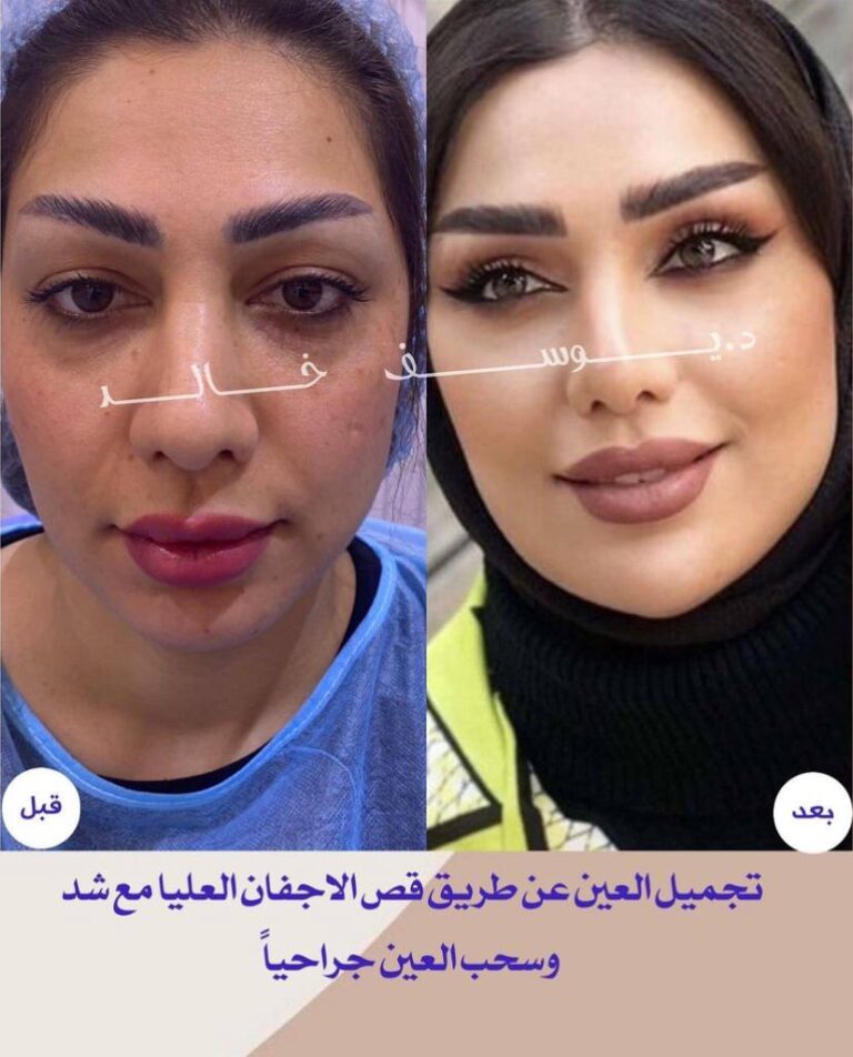 شد وسحب العين 768x952