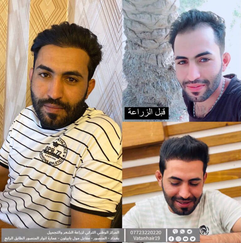 شعر زراعه 1 768x774