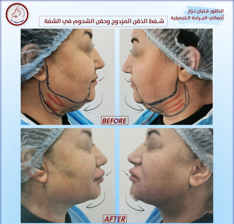 شفط الذقن 768x735