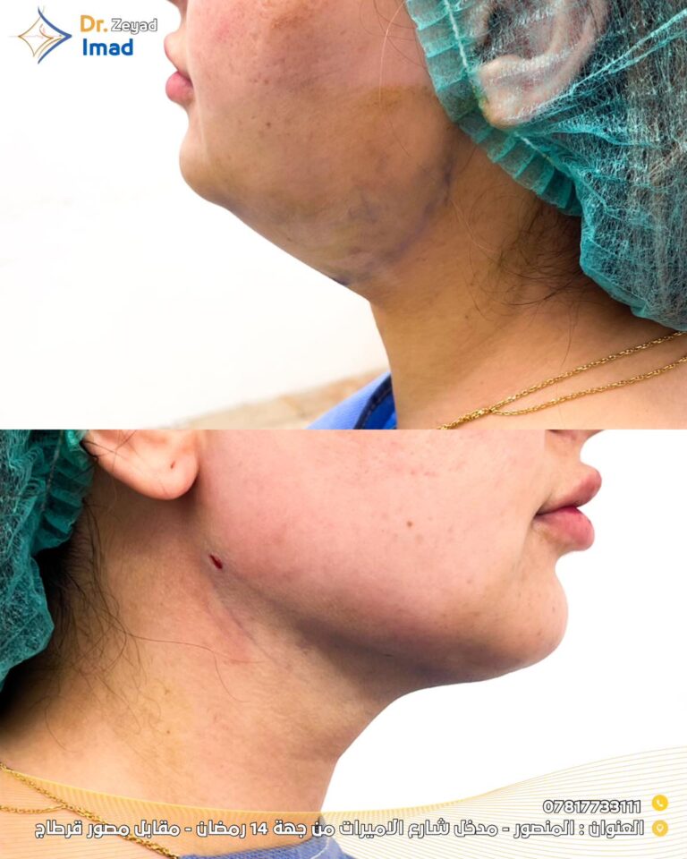 شفط الذقن المزدوج 1 768x960