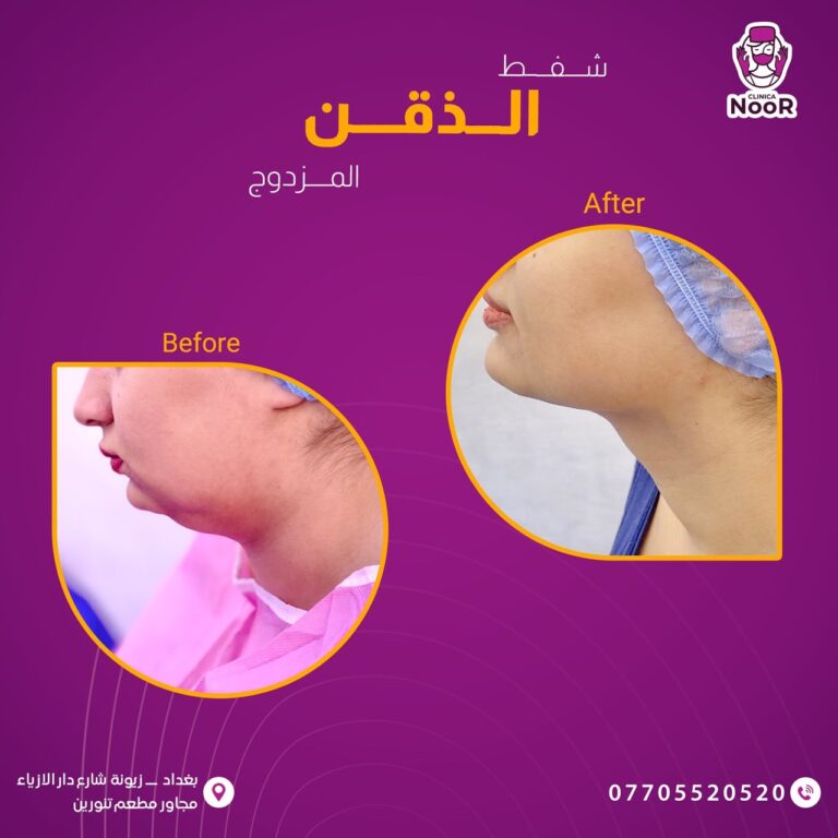 شفط الذقن المزدوج 768x768