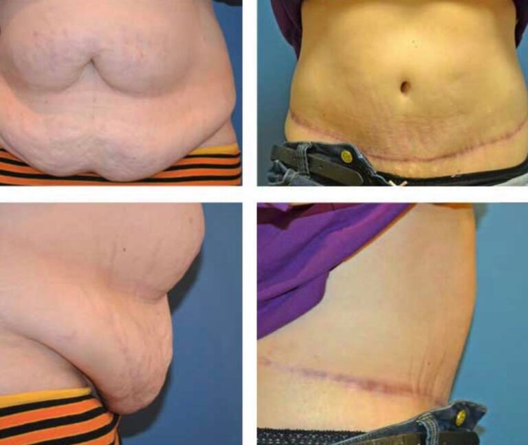 شفط دهون البطن 768x648