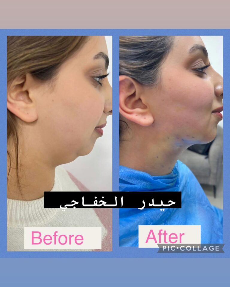 شفط ذقن مزدوج 768x960