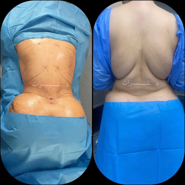 شفط شحوم الظهر 768x768