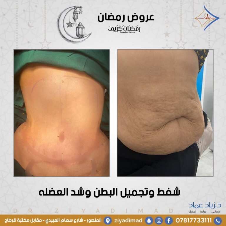شفط وتجميل البطن 768x769