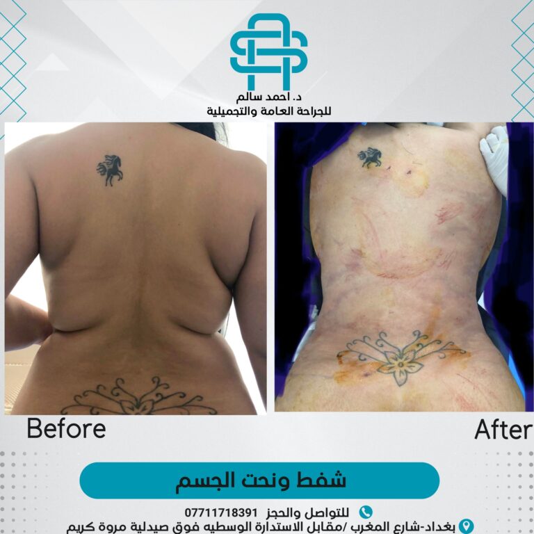 شفط ونحت الجسم 768x768