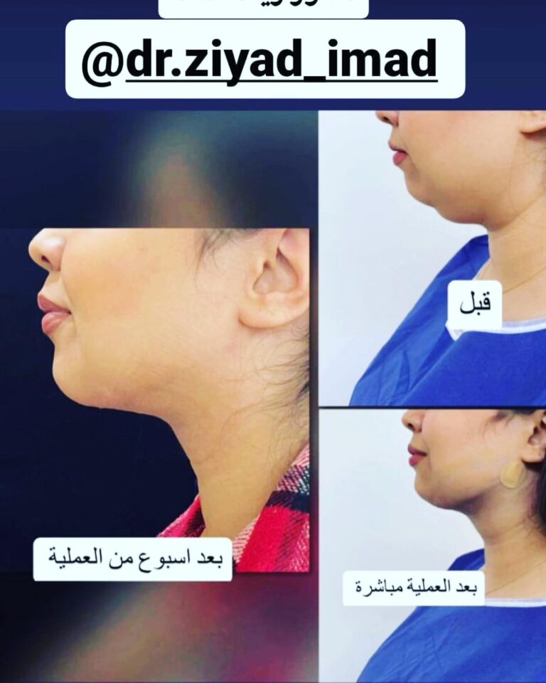 شفط ونحت الذقن 768x960