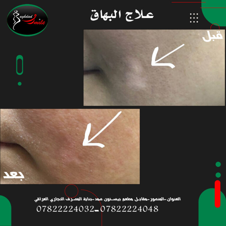 علاج البهاق 768x768