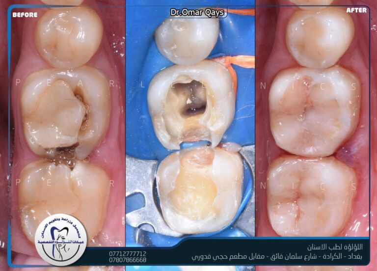 علاج الحشوات 768x552